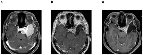 Cancers | Free Full-Text | Management of Medial Sphenoid Wing Meningioma Involving the Cavernous ...