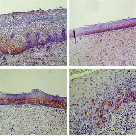 Examples of different CIN II lesions and of the corresponding p16 ...