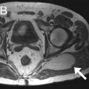 MRI of intramuscular hibernoma. (A) Coronal MRI survey image showing ...