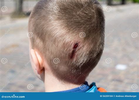 Wound on head injury stock photo. Image of scalp, unconscious - 56209184