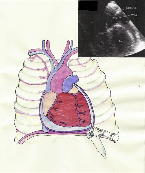 Safety, Efficacy, and Complications of Pericardiocentesis by Real-Time ...