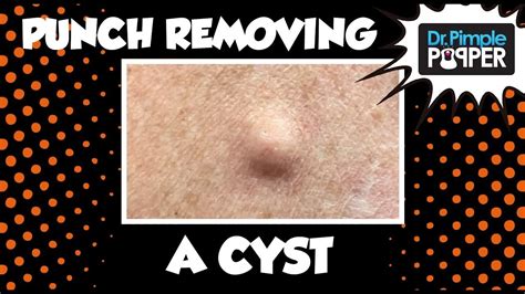 A Punch Removal of a Cyst! With Dr Pimple Popper - Pimple Popping Videos