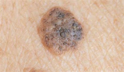 Seborrheic Keratosis vs. Melanoma | Vujevich Dermatology Associates