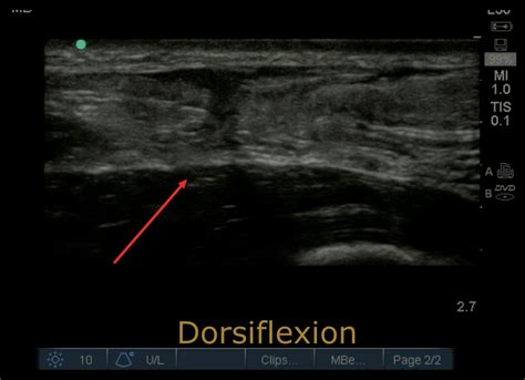 Ultrasonographic Findings of Acute Achilles Tendon Rupture - JETem