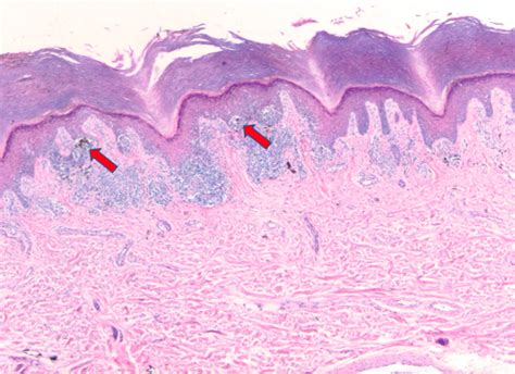 Melanocytes Histology