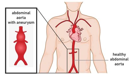 Abdominal Aortic Aneurysm: Causes, Treatment and Prevention