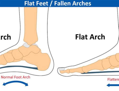 The Benefits of Arch Supports – Footcare Express