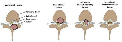 Classification of tumors of the spinal cord and spine by topographic... | Download Scientific ...