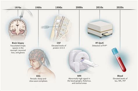 Laboratory Diagnosis of Creutzfeldt–Jakob Disease | NEJM