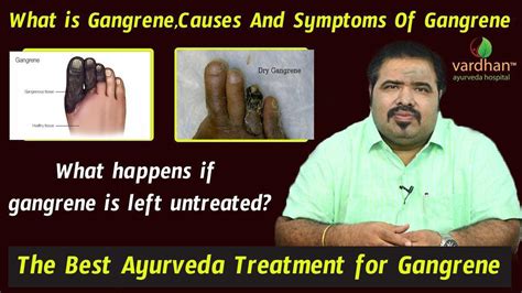 What is Gangrene : Causes,Symptoms | Safest Treatment For Gangrene : Dr VARDHAN