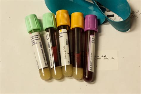 Hematocrit and hemoglobin | Cardiovascular Disorders and Diseases ...