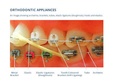 Metal vs porcelain braces — Hugo Orthodontics