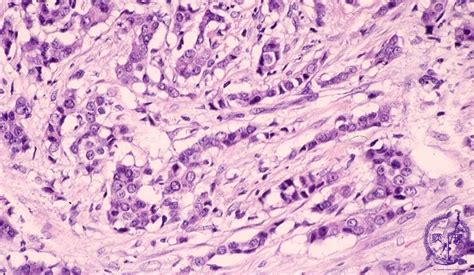 Invasive Ductal Carcinoma Histology