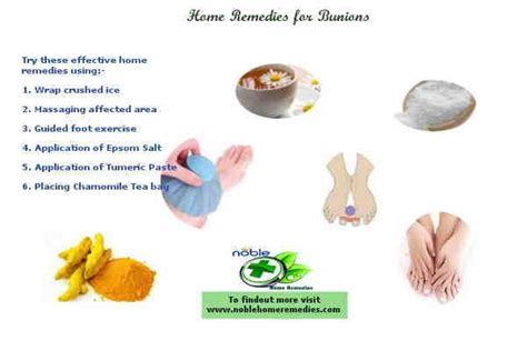 Home Remedies for Bunions