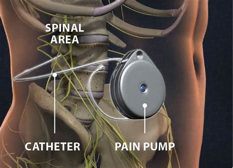 What is a Pain Pump or Intrathecal Drug Delivery System?