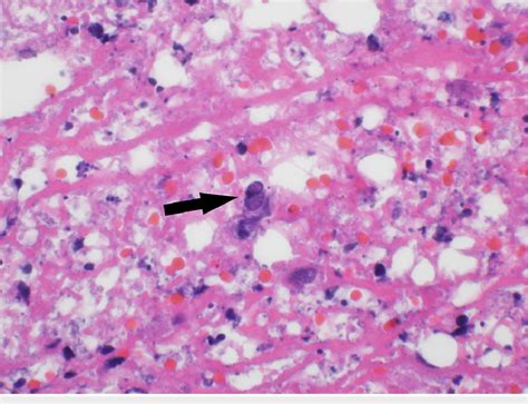 Histology of patient's skin biopsy demonstrating multinucleated cell... | Download Scientific ...