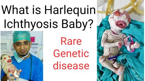 Harlequin Ichthyosis Baby|Second Rare Genetic disease Baby in India|what is Harlequin Ichthyosis ...