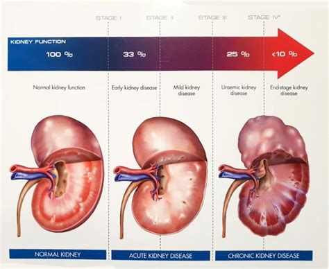 Stages Of Chronic Kidney Disease Chart