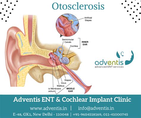 Otosclerosis Surgery Cost & Treatment - Best Otosclerosis Doctor Delhi ...