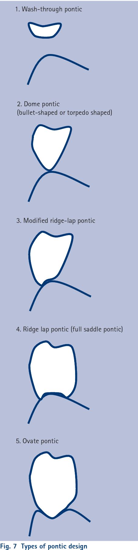 Types of bridge pontics | Dental bridge, Dentistry, Dental ceramics