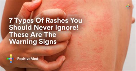 7 Types of Rashes You Should Never Ignore These Are The Warning Signs