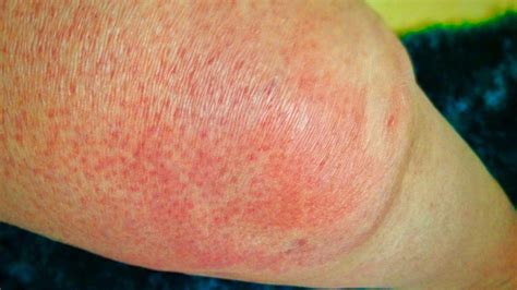 Cellulitis – 6 Fast Facts That You Should Know