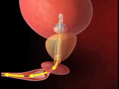 Urethral Catheter and Prostatic Stent Introduction - YouTube