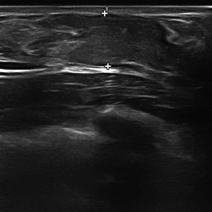 Breast ultrasound confirming gynecomastia. Size: right 3.016 mm and... | Download Scientific Diagram