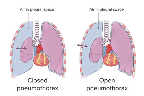 Tension Pneumothorax Diagram