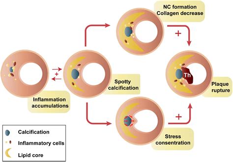 Frontiers | Calcification in Atherosclerotic Plaque Vulnerability: Friend or Foe?