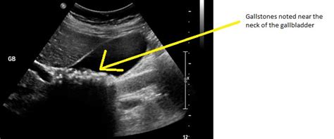 Gallstone disease ultrasound - wikidoc