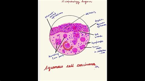 Squamous Cell Carcinoma