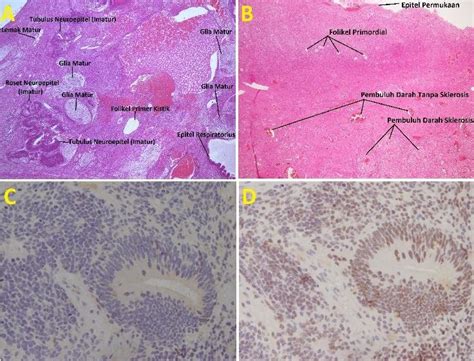 Teratoma Histology