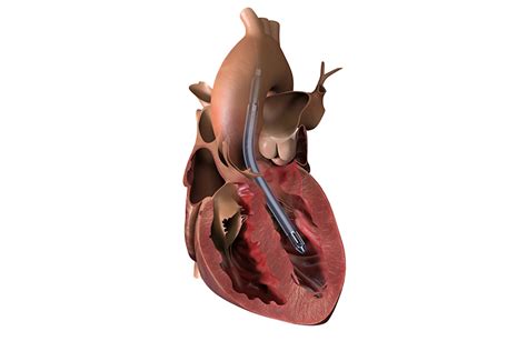 Abiomed touts results of U.S. study of its latest Impella heart pump - MassDevice