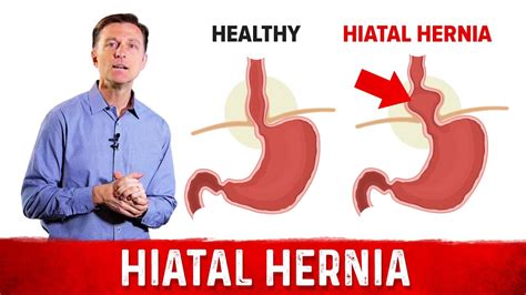 Hiatal Hernia: The Best Home Treatment | Sports Health & WellBeing