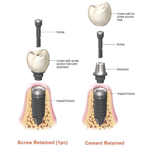 Understanding Dental Abutments