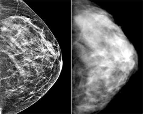 Abnormal Mammogram Findings