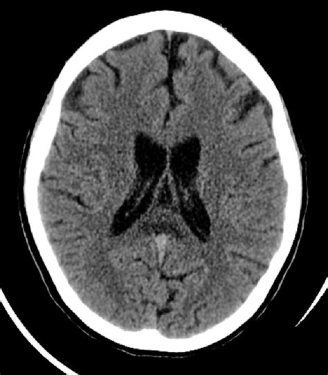 TC showing hypodense corpus callosum splenium. | Download Scientific Diagram