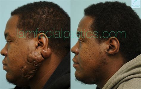 Keloid Treatment Before & After Photos | Lam Facial Plastics