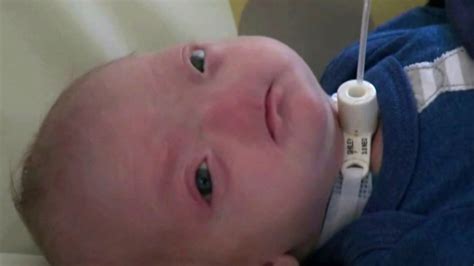 Adorable baby born without a nose | KABC7 Photos and Slideshows | abc7.com