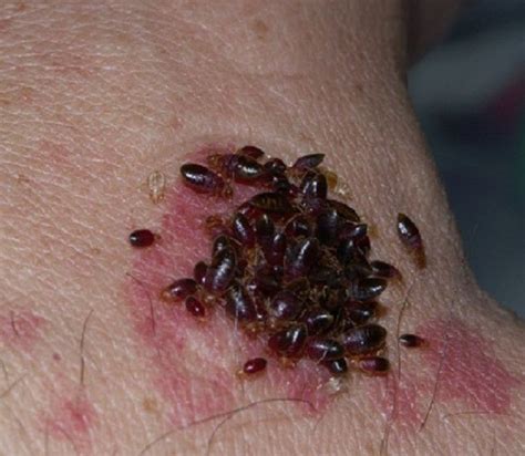 What Does Bed Bug Bites On Black People Skin? | Pest Professional Services