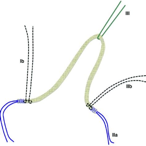 An intraoperative image of the harvested palmaris longus tendon graft... | Download Scientific ...