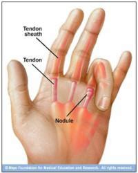 Repetitive Stress Injury Treatment: Trigger Finger Splint from ...