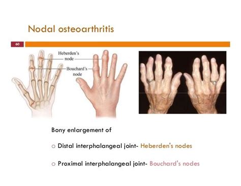 heberden's nodes - Google Search | Osteoarthritis, Okay gesture, Joint