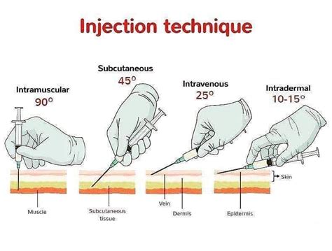 Iv Injection Sites Diagram Arm