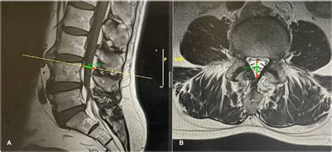 Measurements of spinal epidural lipomatosis on magnetic resonance... | Download Scientific Diagram