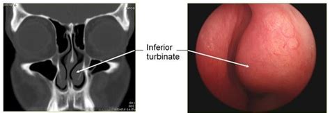 Septum And Turbinate Surgery