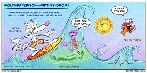 Wolff–Parkinson–White syndrome | Medcomic