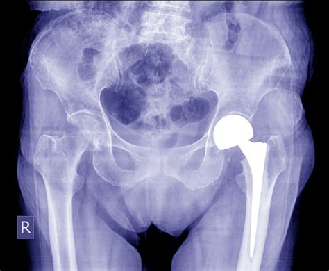 Premium Photo | Total hip arthroplasty, x-ray image very good quality show post operation at hip.