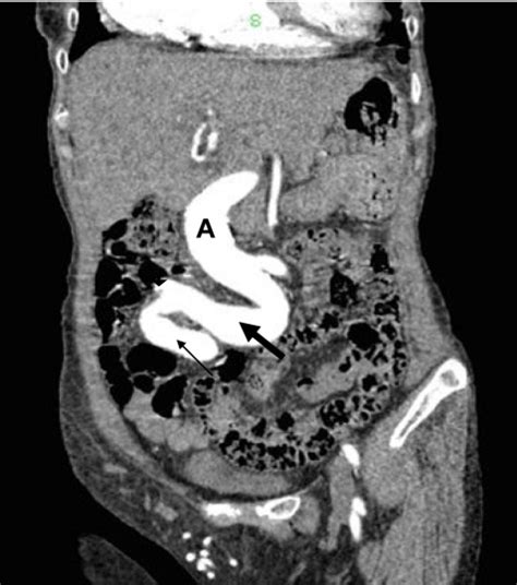 Coronal reconstruction of CT scan shows tortuous atherosclerotic... | Download Scientific Diagram